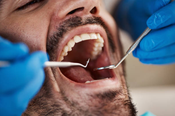 Best Emergency Tooth Extraction in Cottonde, AL
